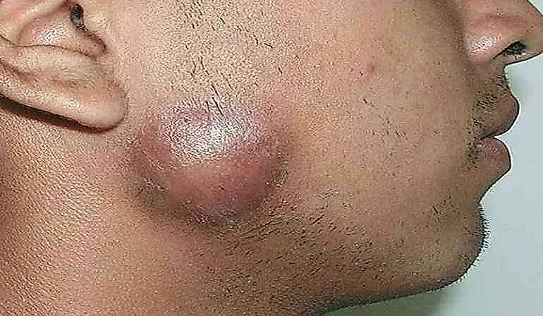 Телец Донована, или донованоз