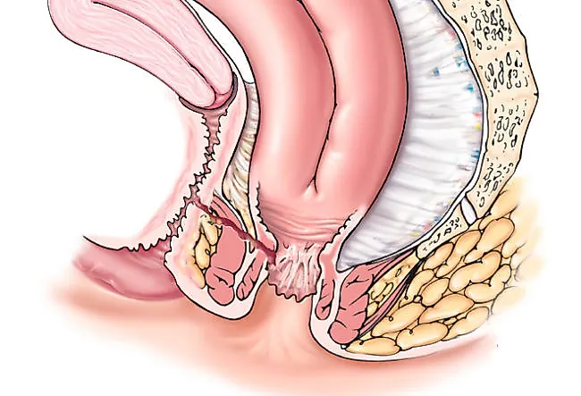 Пузырно-влагалищный свищ