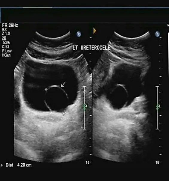 Уретероцеле