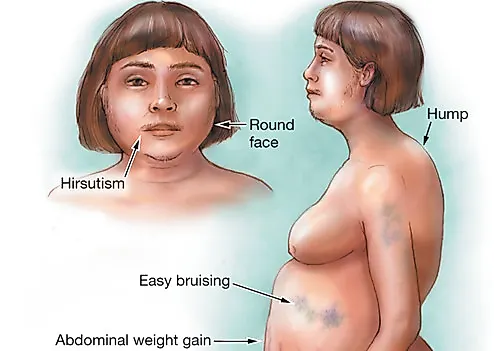 Синдром кушинга