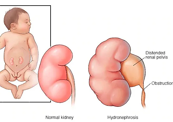 Обструкция лоханочно-мочеточникового сегмента