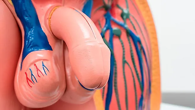 Варикоцеле