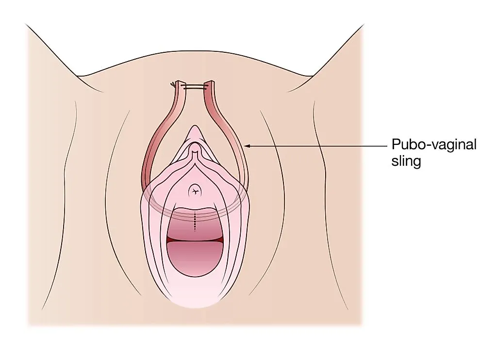 Интерлабиальные объемные образования