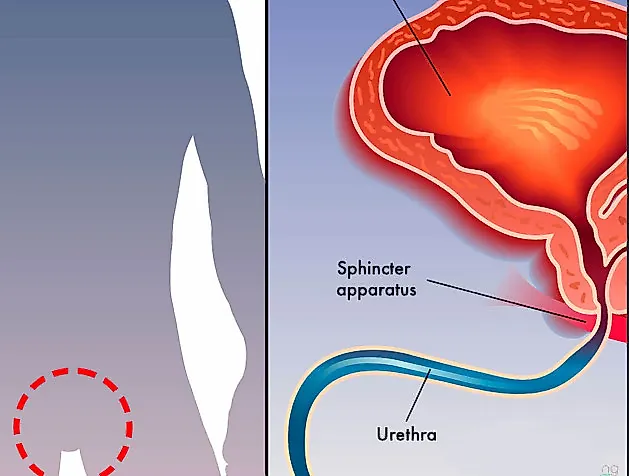 Приобретенная стриктура мочеиспускательного канала