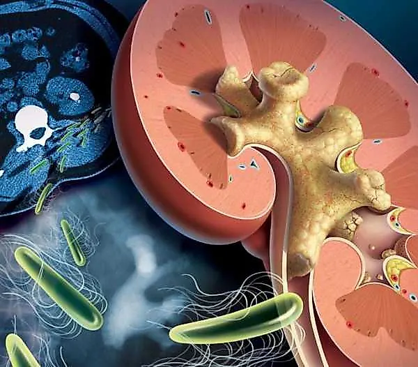 Коралловидные камни