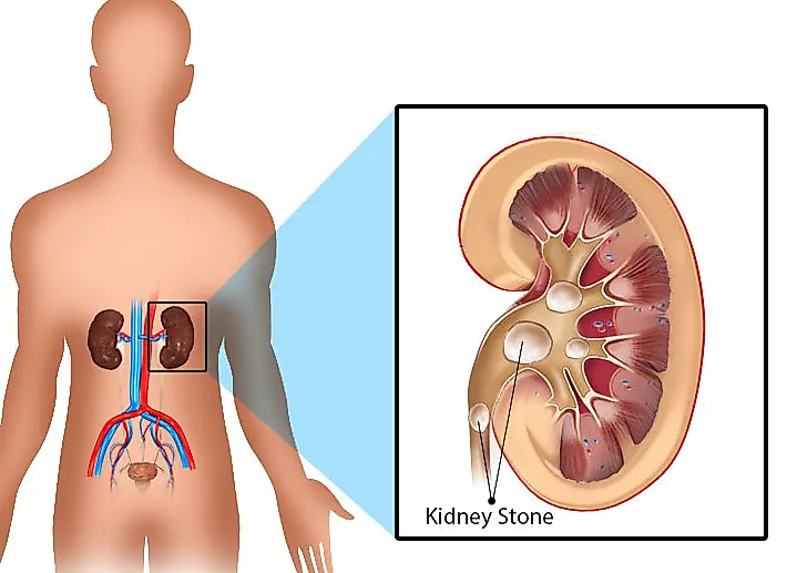 Оксалатный уролитиаз
