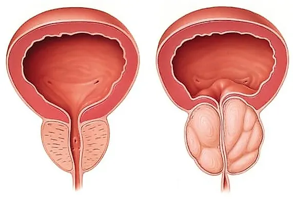 Аденома предстательной железы