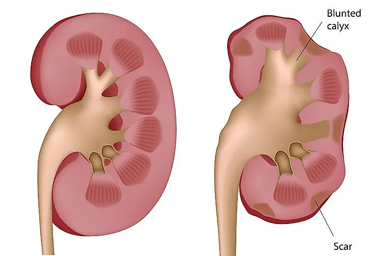 Пиелонефрит