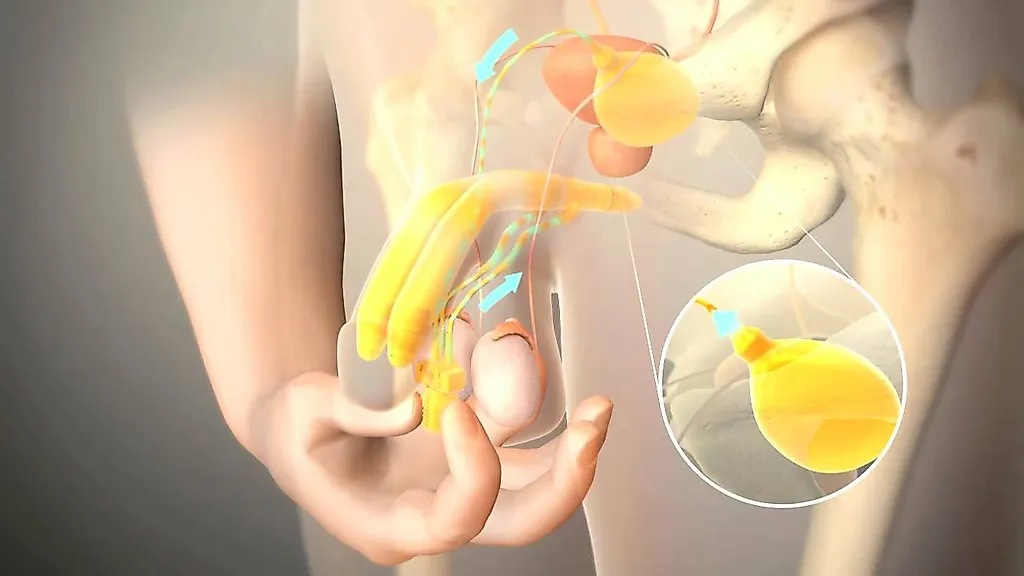 Пластика полового члена