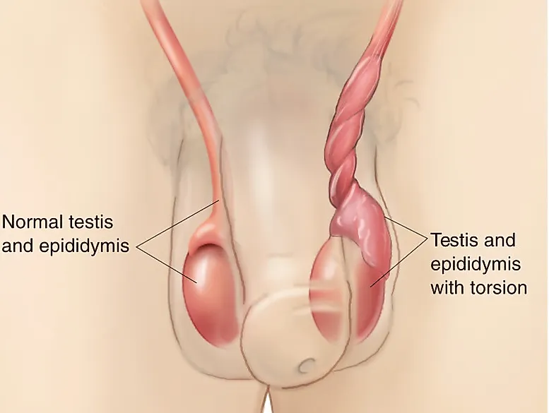 Абсцесс мошонки