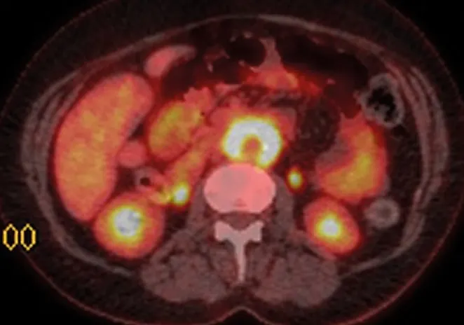 Ретроперитонбальный фиброз