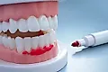 Кровоточивость десен: причины, лечение и когда нужно срочно к стоматологу