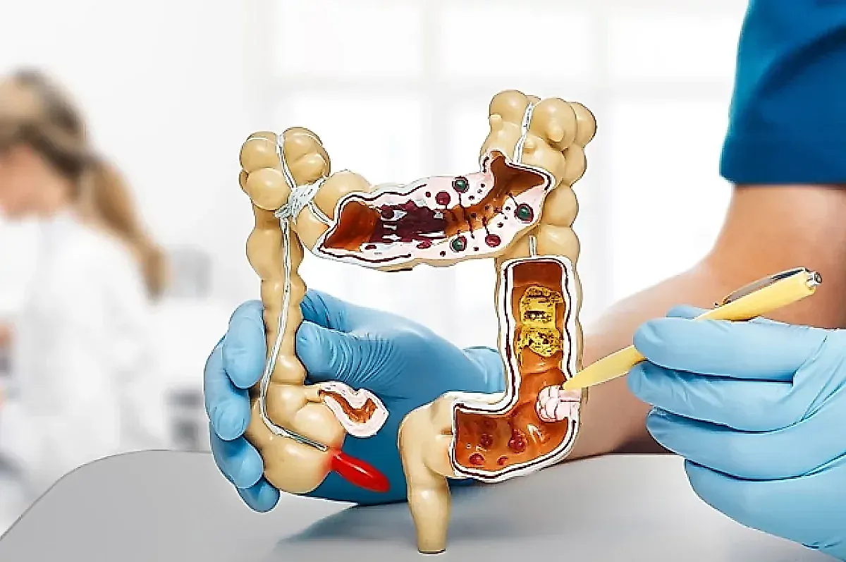 10 советов врача для снижения риска рака кишечника: факты и рекомендации