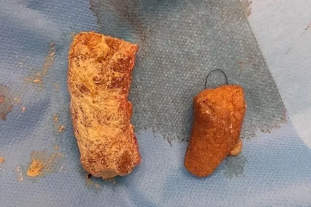 Фитобезоар из хурмы: как зимний фрукт может привести к операции и как этого избежать