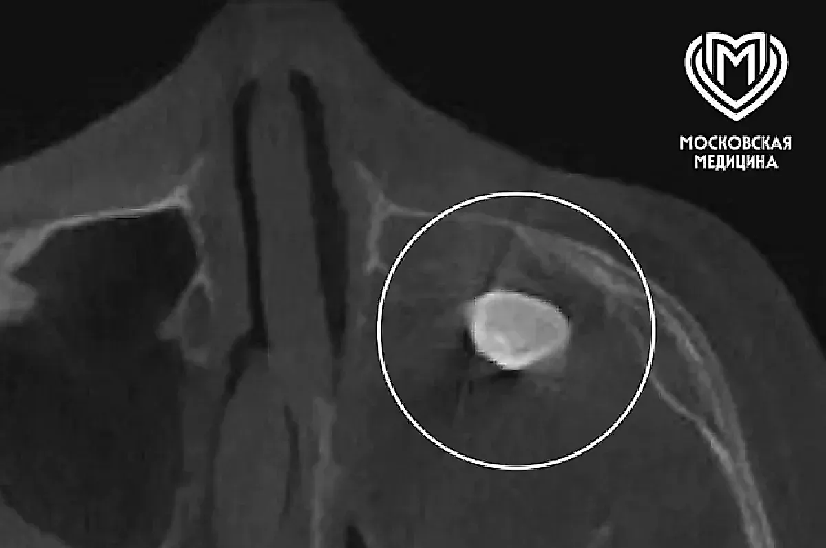 Уникальный случай в Филатовской больнице: врачи удалили зуб из носа подростка, обнаружив редкую тератому