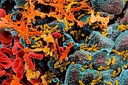 Цистит и кариес могут ускорить развитие деменции