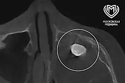 Уникальный случай в Филатовской больнице: врачи удалили зуб из носа подростка, обнаружив редкую тератому