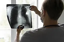 Скрытый туберкулёз: признаки, диагностика и профилактика от врачей Бобровой и Лебедева