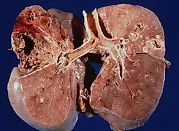 Туберкулез почки