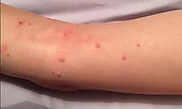 Вирус контагиозного моллюска