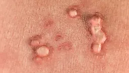 Половые бородавки