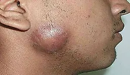 Телец Донована, или донованоз