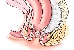 Пузырно-влагалищный свищ