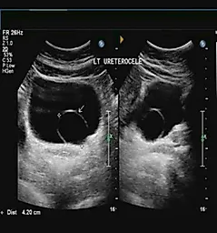 Уретероцеле