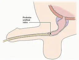 Клапаны  уретры