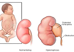 Обструкция лоханочно-мочеточникового сегмента