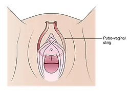 Интерлабиальные объемные образования
