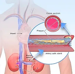 Патология почечной артерии