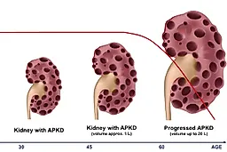 Поликистоз почек у взрослых