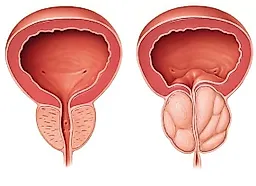 Аденома предстательной железы