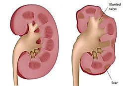 Пиелонефрит