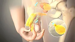 Пластика полового члена