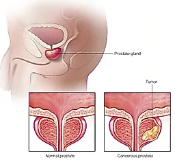 Рак предстательной железы