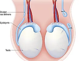 Вазэктомия