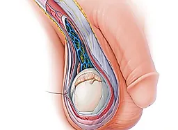 Сперматоцистит