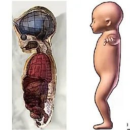 Генетические расстройства