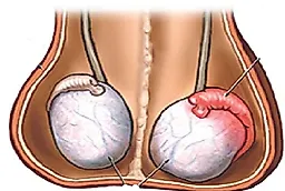 Эпидидимит