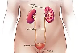 Заболевания мочевых путей у женщин