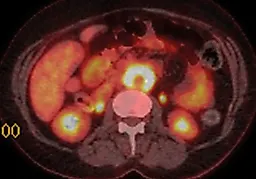 Ретроперитонбальный фиброз