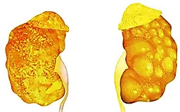 Почечный абсцесс