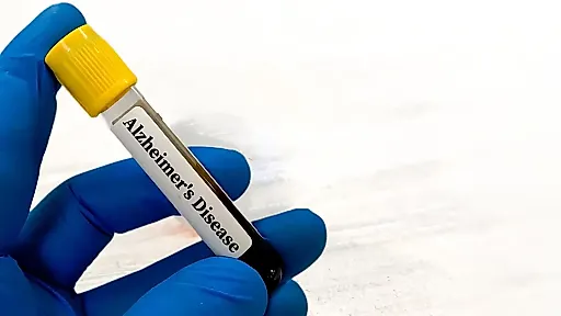 Проблемы с почками могут искажать тесты на болезнь Альцгеймера