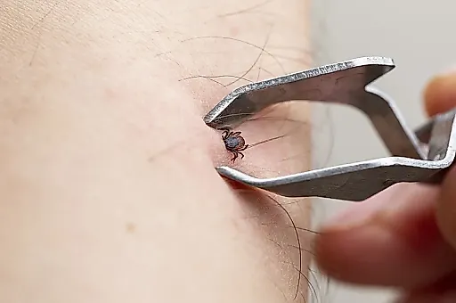 Укус клеща: что делать в первые 3 дня, советы врача Романа Фишкина