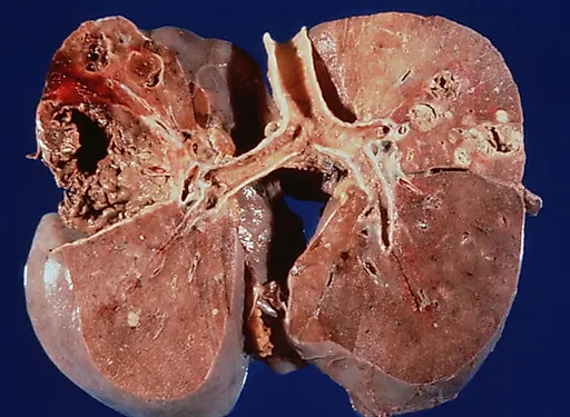 Туберкулез почки