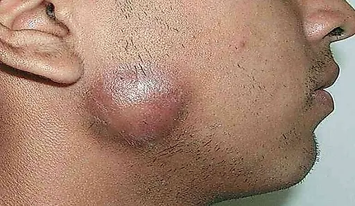 Телец Донована, или донованоз