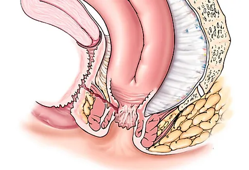 Пузырно-влагалищный свищ