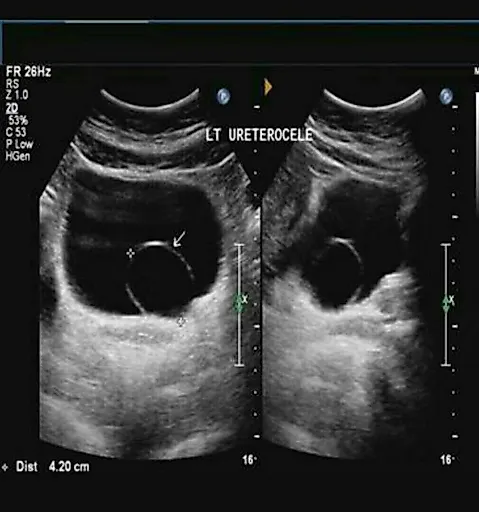 Уретероцеле